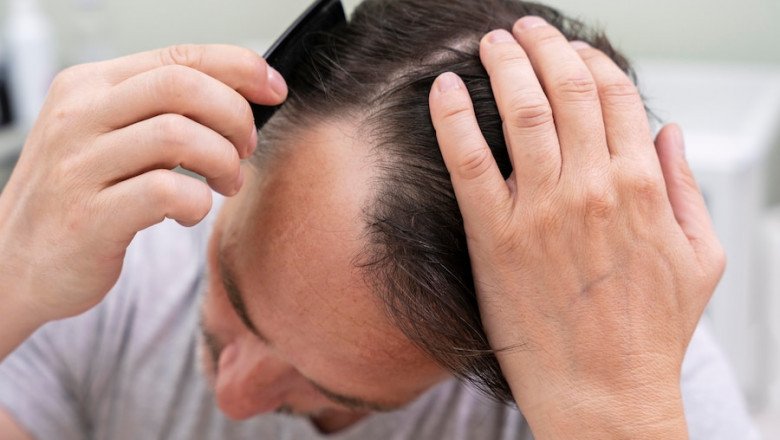 The 6 most common types of alopecia in men