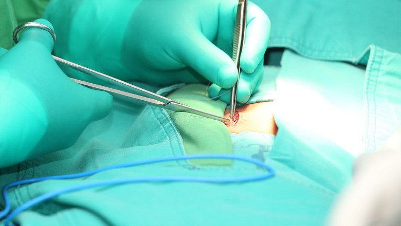 Hernia Repair Market is expected to reach US$ 6.5 Billion by 2027