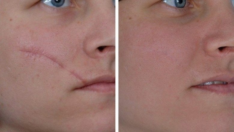 Among the scar treatment available today, which is the best and most effective?