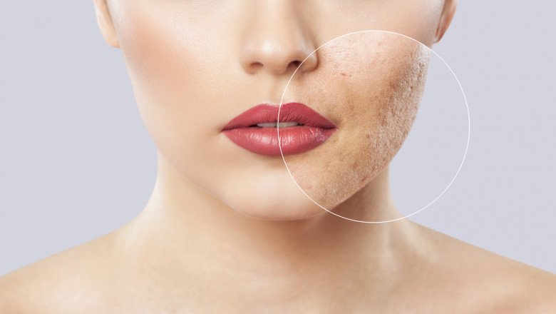 Scar Treatment Market: Global Industry Trends, Share, Size, Growth, Opportunity and Forecast 2022-2030