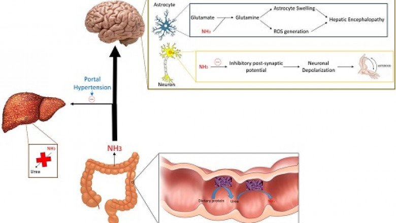 Hepatic Encephalopathy Market : Global Industry Trends, Share, Size, Growth, Opportunity and Forecast 2020-2027