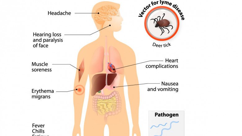 Lyme Disease Treatment Market Observes Tremendous Rise during the Forecast 2022-2028