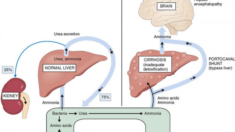 A Disorder Of The Brain That Occurs In Some Liver Disease Patients Is Hepatic Encephalopathy