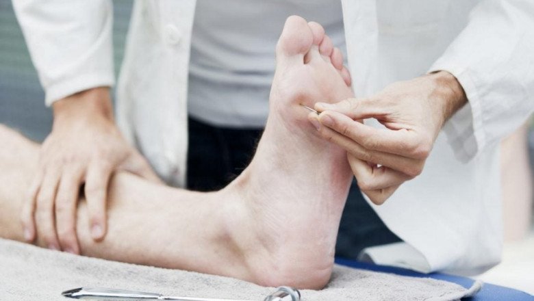 One In Five Patients With Type 1 Or Type 2 Diabetes Mellitus (DM) Will Experience Diabetic Neuropathy
