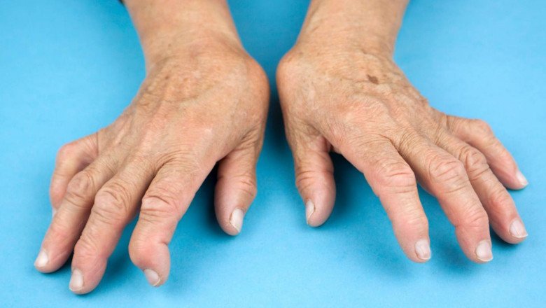 There Are Rheumatoid Arthritis Treatment That Help Alleviate Symptoms And Improve Joint Function