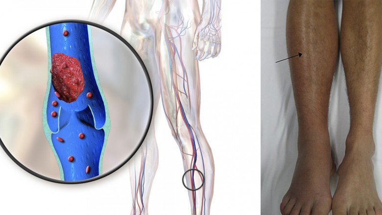 Venous Thromboembolism (VTE) Refers To A Blood Clot Forming In A Deep Vein, Called A Thrombi