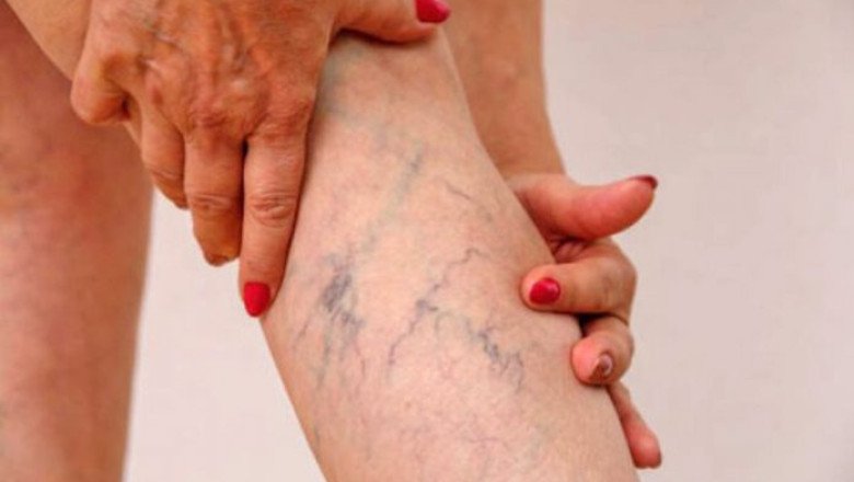 As The Severity Of The Disease, The Organs Affected, And Its Underlying Cause Determine The Vasculitis Treatment