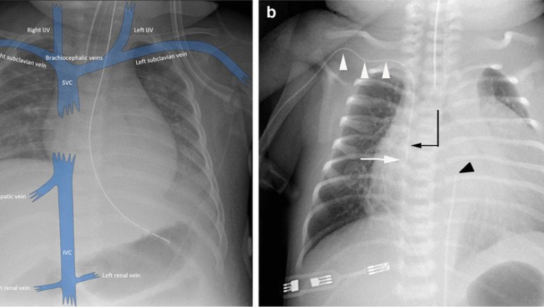 You Receive A Central Venous Catheter (CVC) From Your Healthcare Provider So They Can Insert It Into A Vein In Your Neck, Chest, Arm, Or Groin