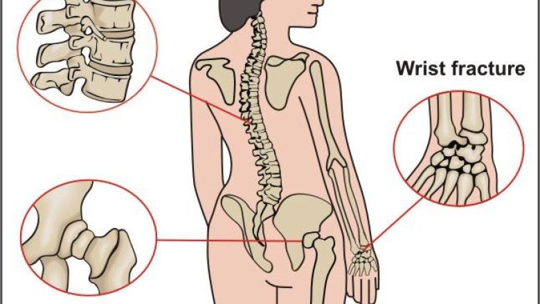 Expert Shares Tips for Preventing Anti-Osteoporosis And Fracture Healing in Older Adults