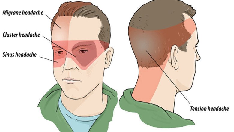 There Is An Associated Stuffy Nose, Tearing Of The Eyes, And Drooping Eyelids With Cluster Headaches