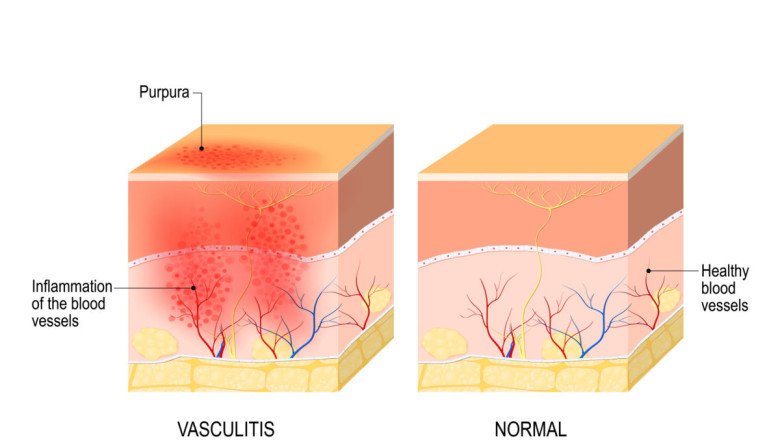 Vasculitis Treatment Varies Depending On The Severity And Organs Affected