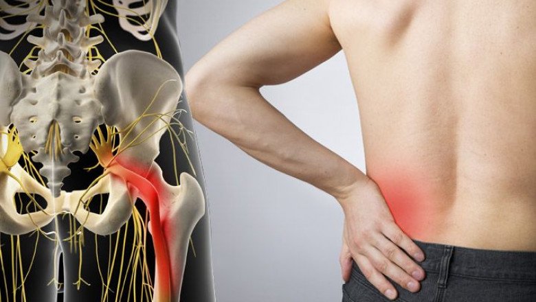 Lower Back Pain Radiates To The Buttock, Then Down To The Leg With Sciatica