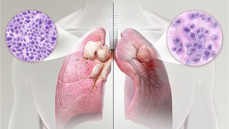 Non-Small Cell Lung Cancer Market Modern Trends, Top Regions and Latest Entries Forecast 2030