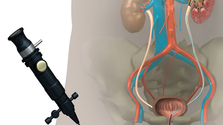 Ureteral Stents Are Soft, Hollow Tubes That Are Temporarily Placed In The Ureter