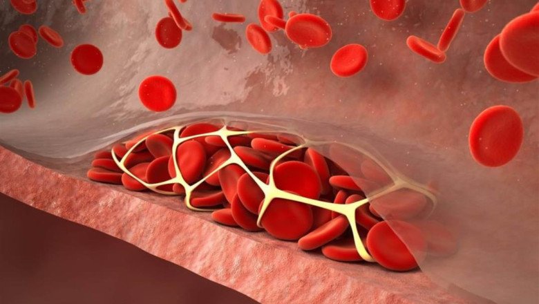Venous Thromboembolism (VTE) Occurs When Blood Gets Stuck In The Veins Of The Legs Or Arms Or When It Travels To The Lungs Through The Veins