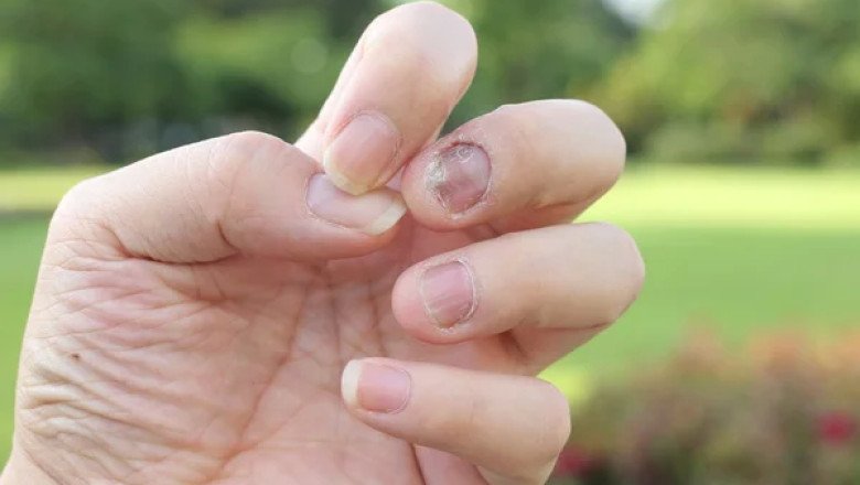 An Onychomycosis Treatment Eliminates The Fungus And Promotes Nail Growth