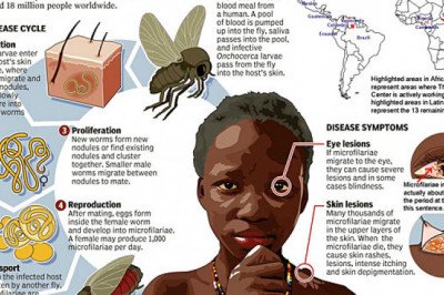 Everything You Should Know About Onchocerciasis (River Blindness)
