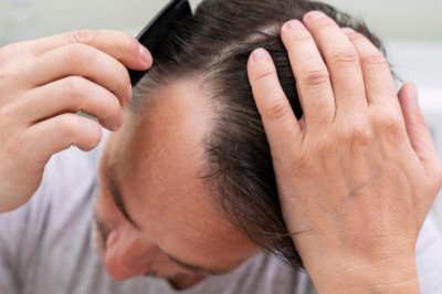 The 6 most common types of alopecia in men