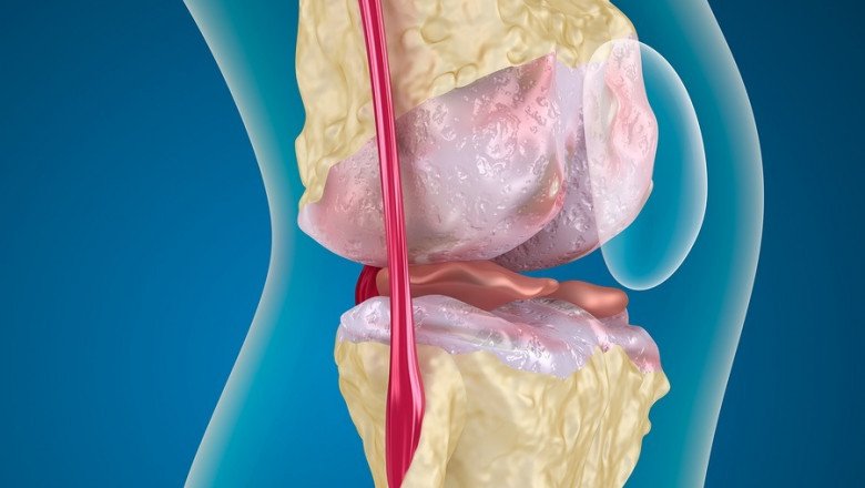 Osteoarthritis Drugs; Help Relieve the Symptoms of Osteoarthritis, Primaril