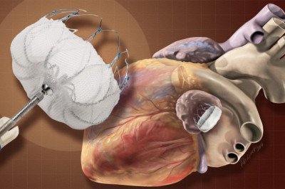 Global Transcatheter Embolization and Occlusion Devices Market: Trends, Share, Size, Growth, Opportunity, and Forecast 2022-2028