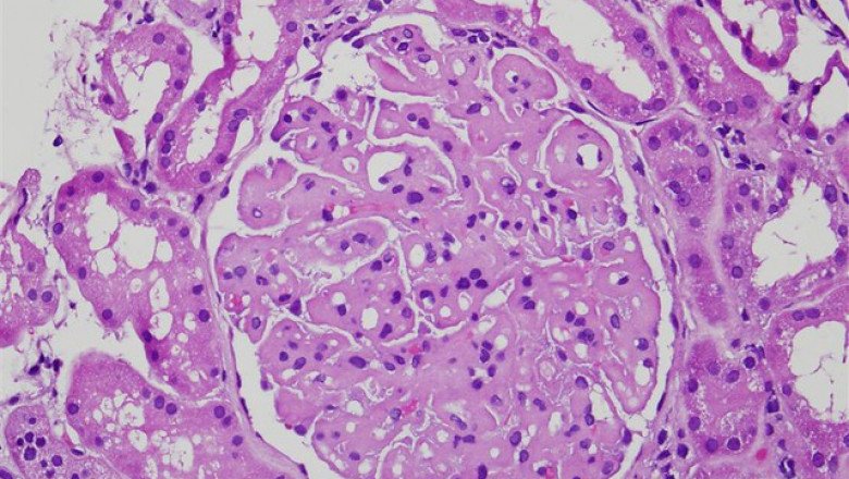 Idiopathic Membranous Nephropathy ; occurs when the tiny blood vessels in the kidneys (glomeruli) that filter waste from the blood become damaged and thickened.