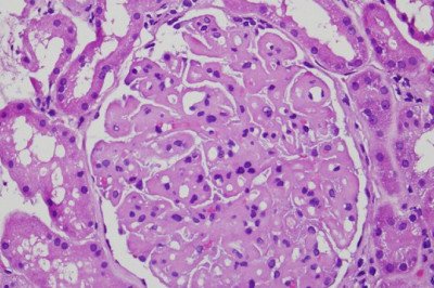 Idiopathic Membranous Nephropathy ; occurs when the tiny blood vessels in the kidneys (glomeruli) that filter waste from the blood become damaged and thickened.