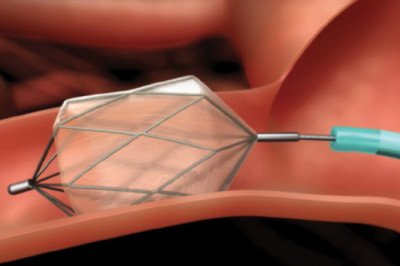 Global Transcatheter Embolization and Occlusion Devices Market : Share, Size, Growth, Opportunity, and Forecast 2022-2028
