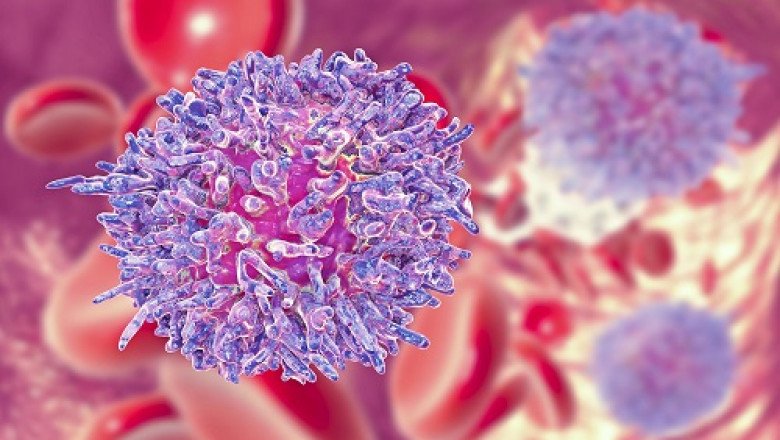 A study of the global Chronic Lymphocytic Leukemia Therapeutics Market : trends, market size, growth, opportunity, as well as forecasts for 2022-2028