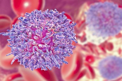 A study of the global Chronic Lymphocytic Leukemia Therapeutics Market : trends, market size, growth, opportunity, as well as forecasts for 2022-2028