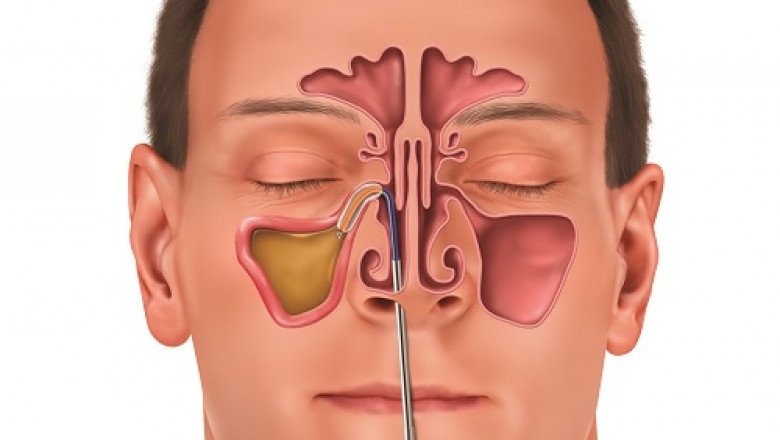 In surgery, sinus dilation devices are used to open up blocked sinus passages, allowing for adequate drainage and airflow