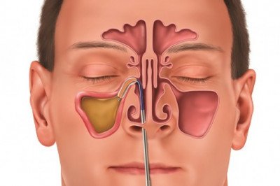 In surgery, sinus dilation devices are used to open up blocked sinus passages, allowing for adequate drainage and airflow