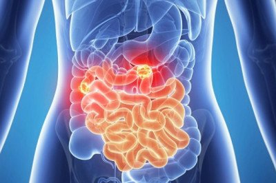 Treatments Stomach Cancer Drugs; drugs that are used to cure the disease
