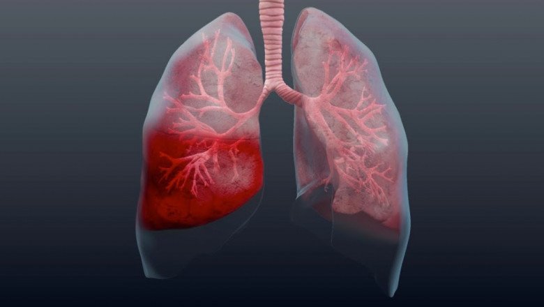 A study of the global Pneumonia Testing Market : trends, market size, growth, opportunity, as well as forecasts for 2022-2028