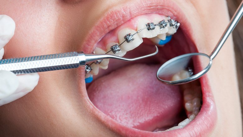 Among other things, dental braces are used to correct crowding, crooked teeth, and other dental problems