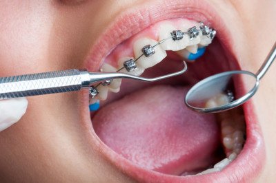 Among other things, dental braces are used to correct crowding, crooked teeth, and other dental problems