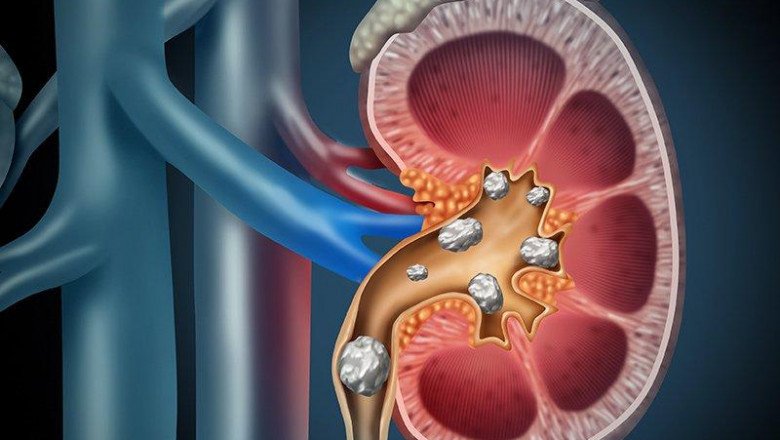 Global Urolithiasis Management Devices Market : Trends, Size, Growth, Opportunity, and Forecast to 2020-2027