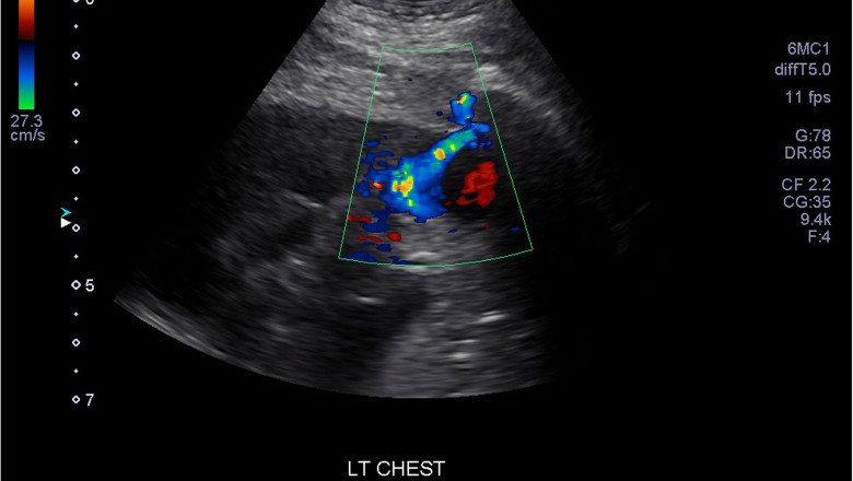 Doppler Ultrasound Examine The Flow Of Blood