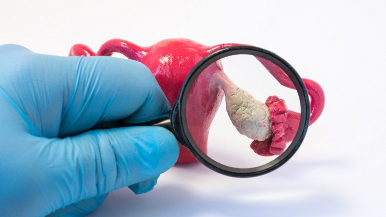 In addition to reducing the risk of other medical conditions, Polycystic Ovary Syndrome Treatment improves the health of the patient