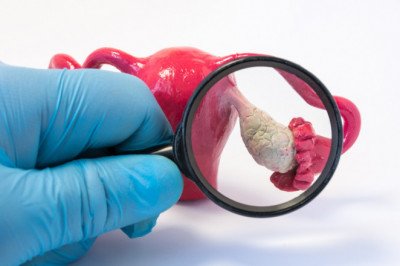 In addition to reducing the risk of other medical conditions, Polycystic Ovary Syndrome Treatment improves the health of the patient