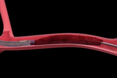 In the medical device industry, Thrombectomy Devices are advancing with increasing technological developments