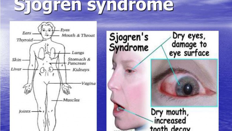 The immune system attacks healthy tissue in Sjogren’s Syndrome, causing a wide range of symptoms