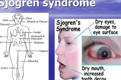 The immune system attacks healthy tissue in Sjogren’s Syndrome, causing a wide range of symptoms
