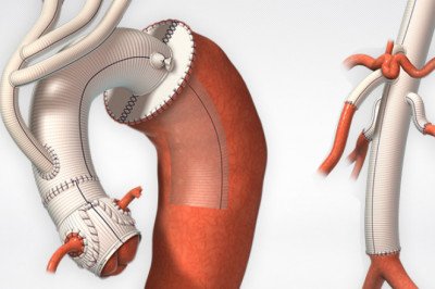 All You Need To Know About Tissue-Engineered Vascular Grafts
