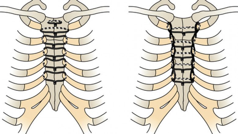 Stabilizes and fixes fractures of the inner chest wall with sternal closure systems