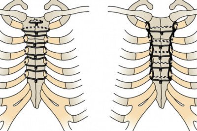 Stabilizes and fixes fractures of the inner chest wall with sternal closure systems
