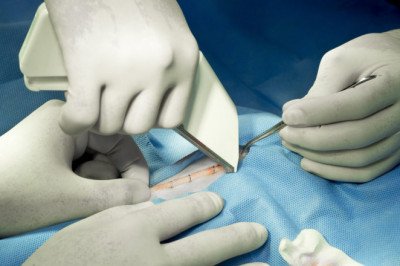 Let’s Know About the Evolution of Surgical Staplers