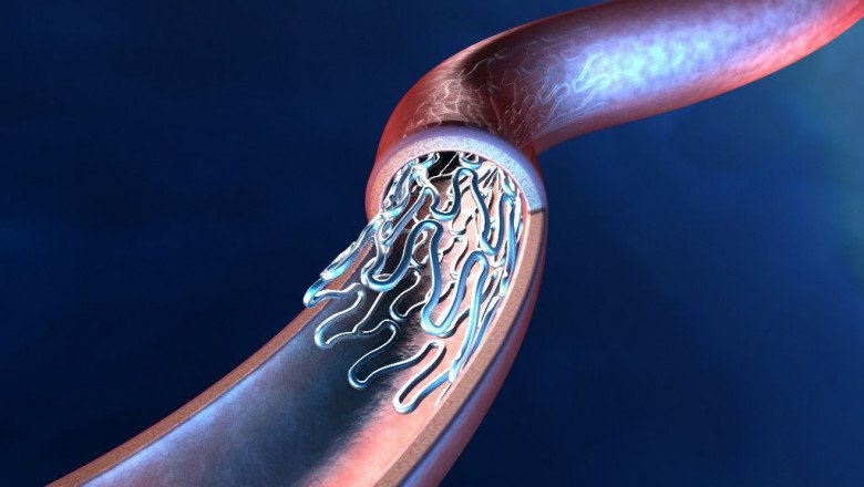 Aneurysms and Deep Vein Thrombosis Can Be Treated With Coronary Stents