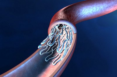 Aneurysms and Deep Vein Thrombosis Can Be Treated With Coronary Stents
