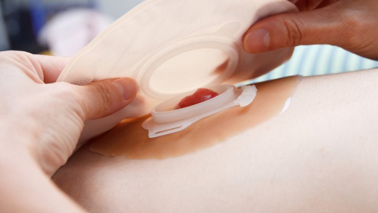 Global Ostomy Care Market : Trends, Size, Growth, Opportunity, and Forecast to 2022-2028