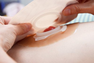 Global Ostomy Care Market : Trends, Size, Growth, Opportunity, and Forecast to 2022-2028